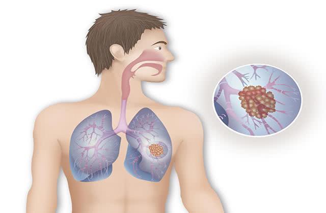 Big Trouble in the Small Ducts of the Lungs: Bronchiectasis 