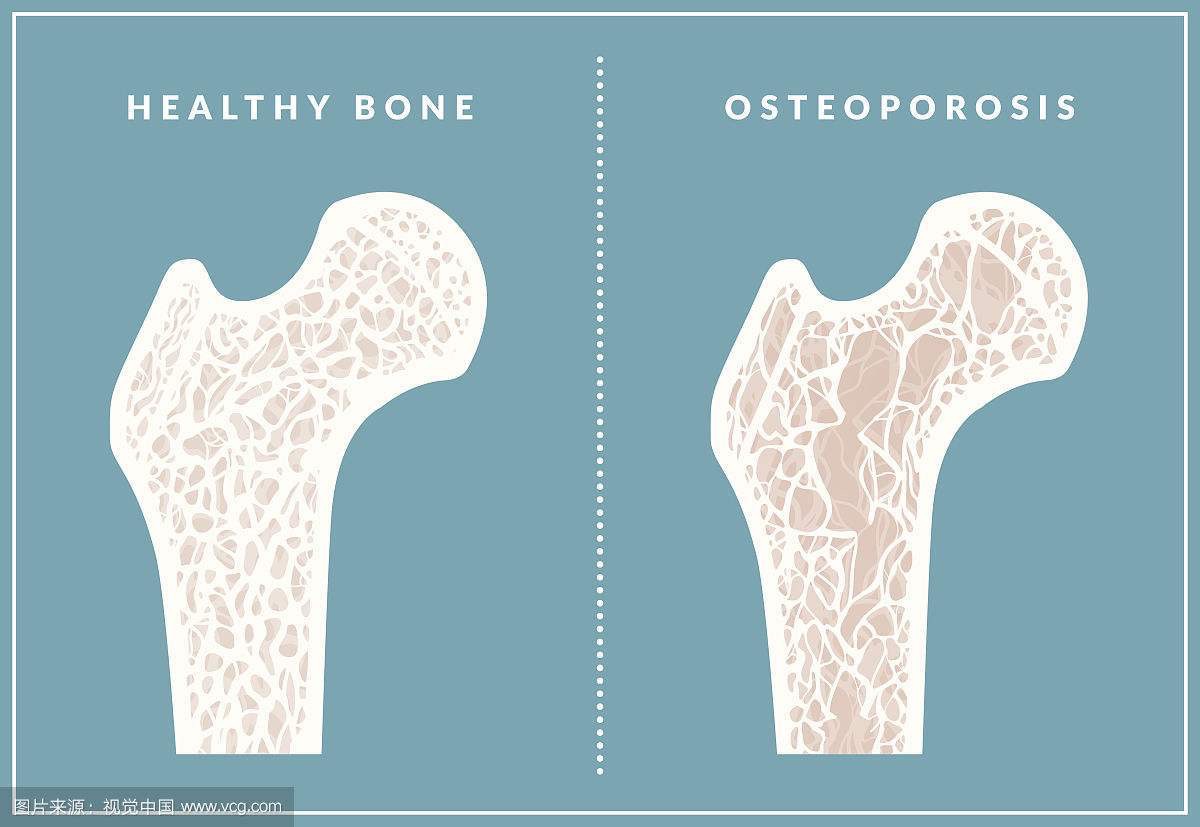 Understanding Osteoporosis and Protecting Your Joint Health