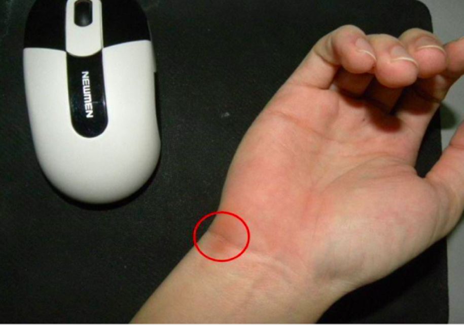 Hidden pain in the wrist may be caused by this thing